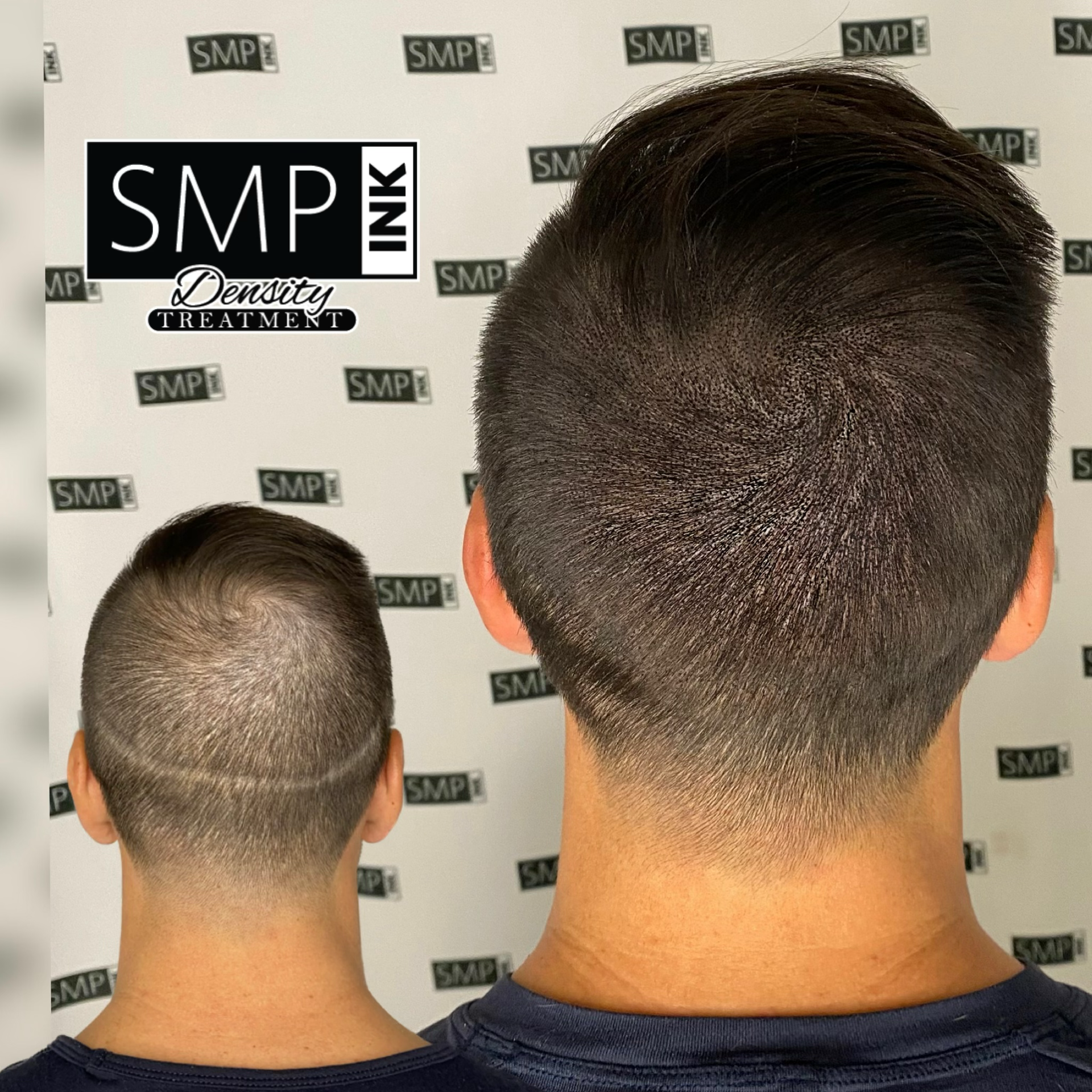 Results of SMP scar camouflage treatment