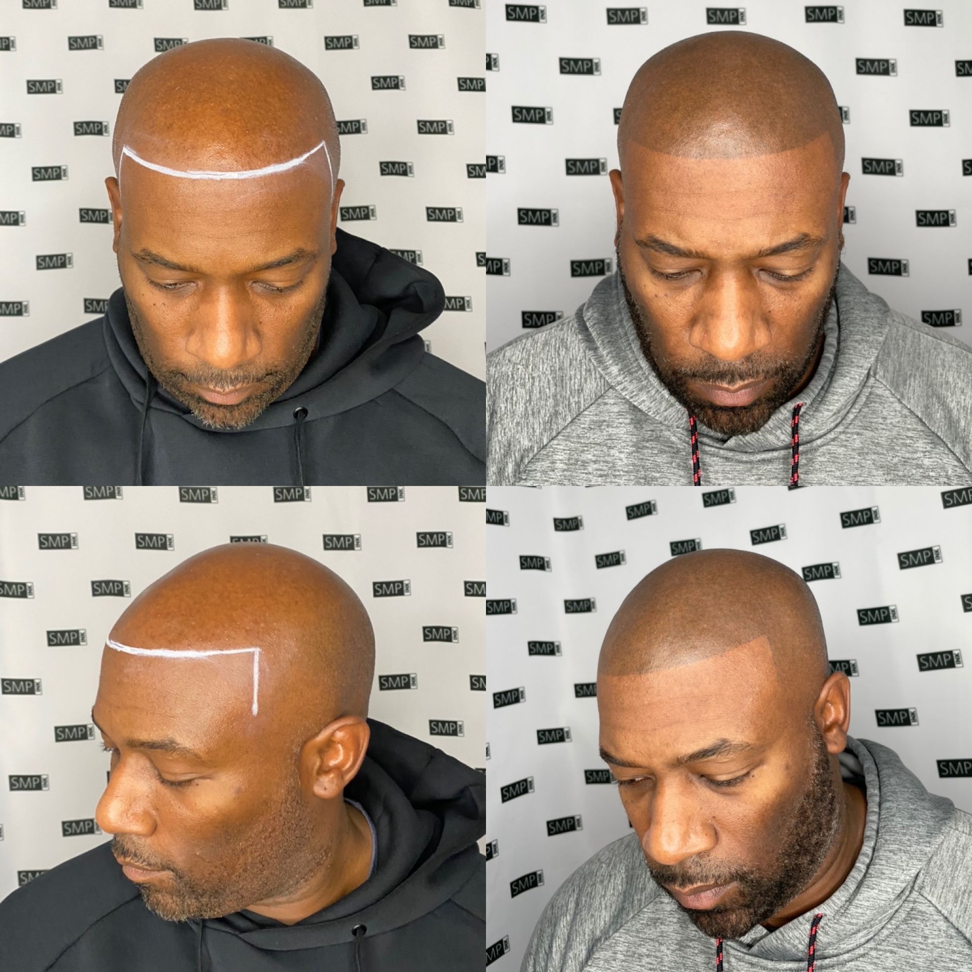 Male Client journey though SMP Treatment
