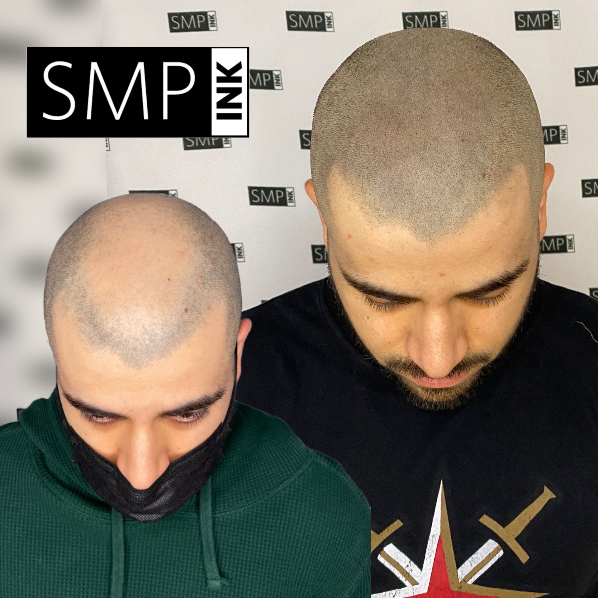Scalp Micropigmentation results of male client