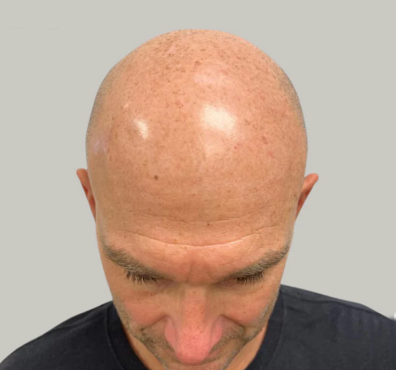 Close-up of a bald head viewed from above, showing a scalp with a small reddish mark.