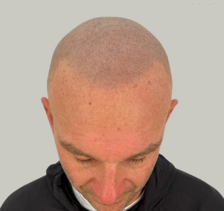 Top-down view of a shaved scalp and forehead against a plain light background
