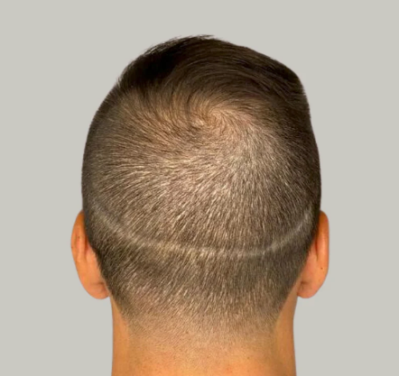 Back of a head with a short buzz cut, showing thinning hair on the crown.