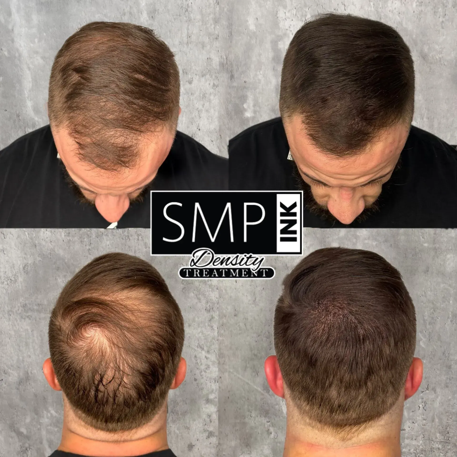 Hair density example with SMP INK CDA