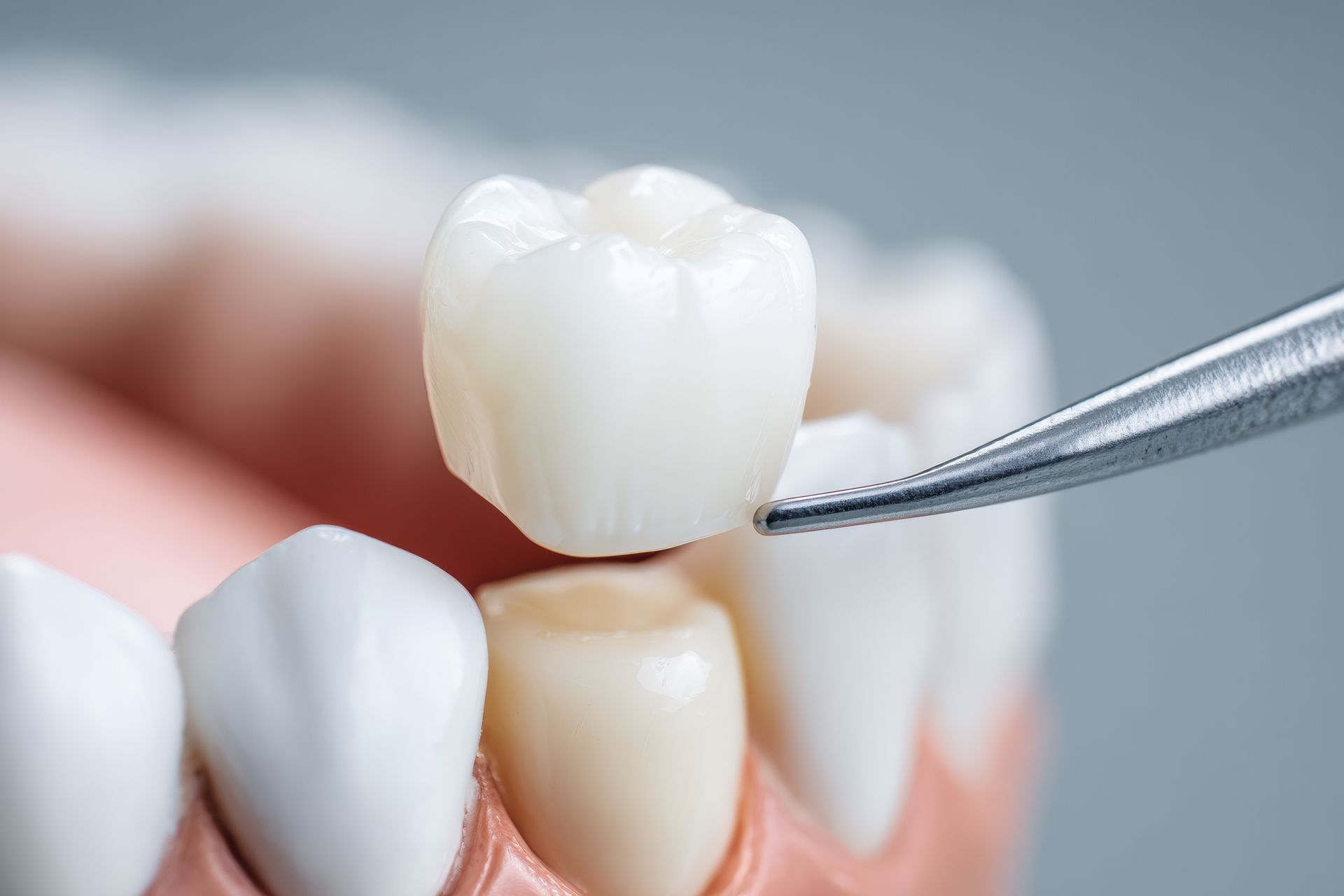 Dentist Places Ceramic Crown on Patient Tooth in Dental Clinic During Treatment Session