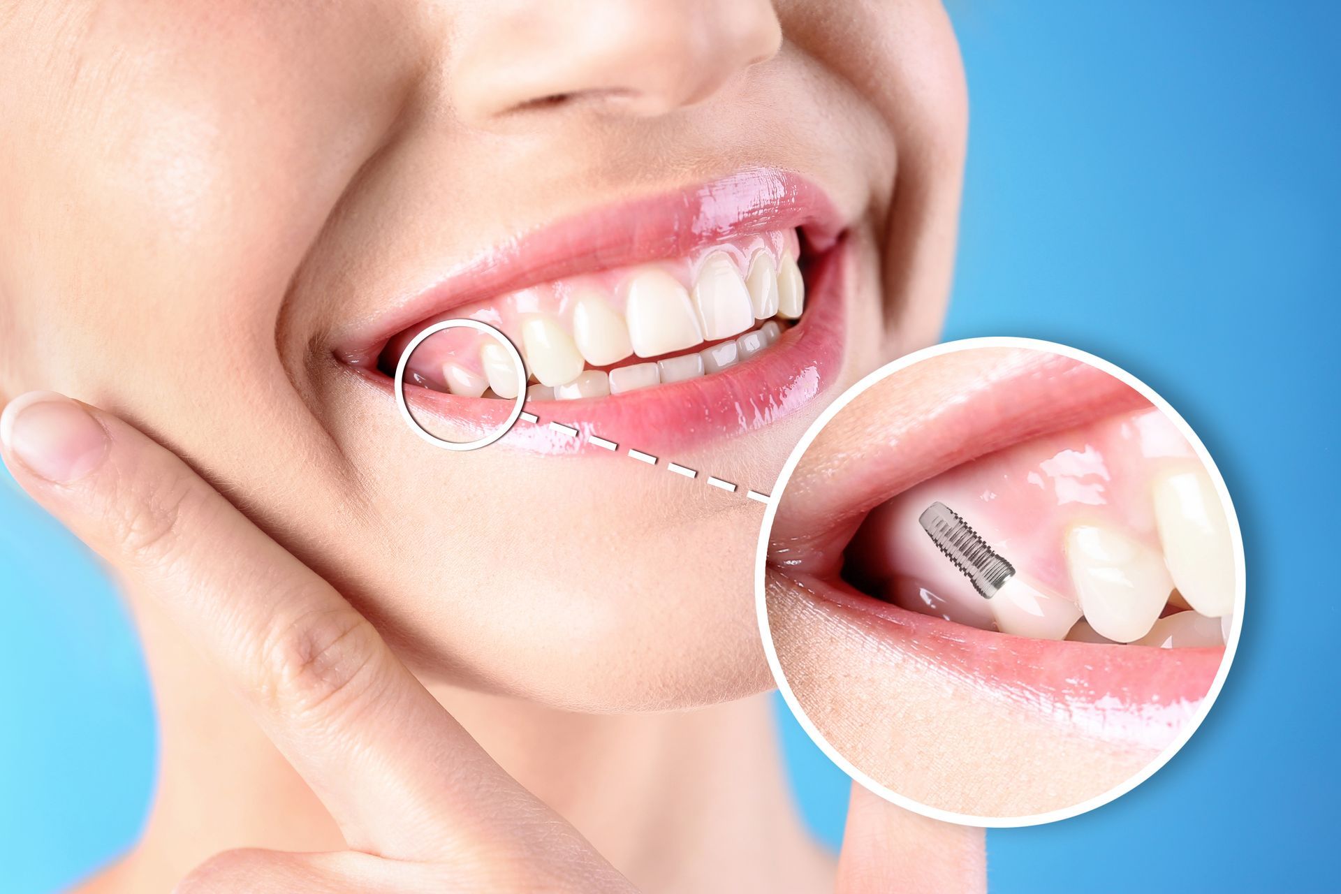 Teeth implant in Baton Rouge LA