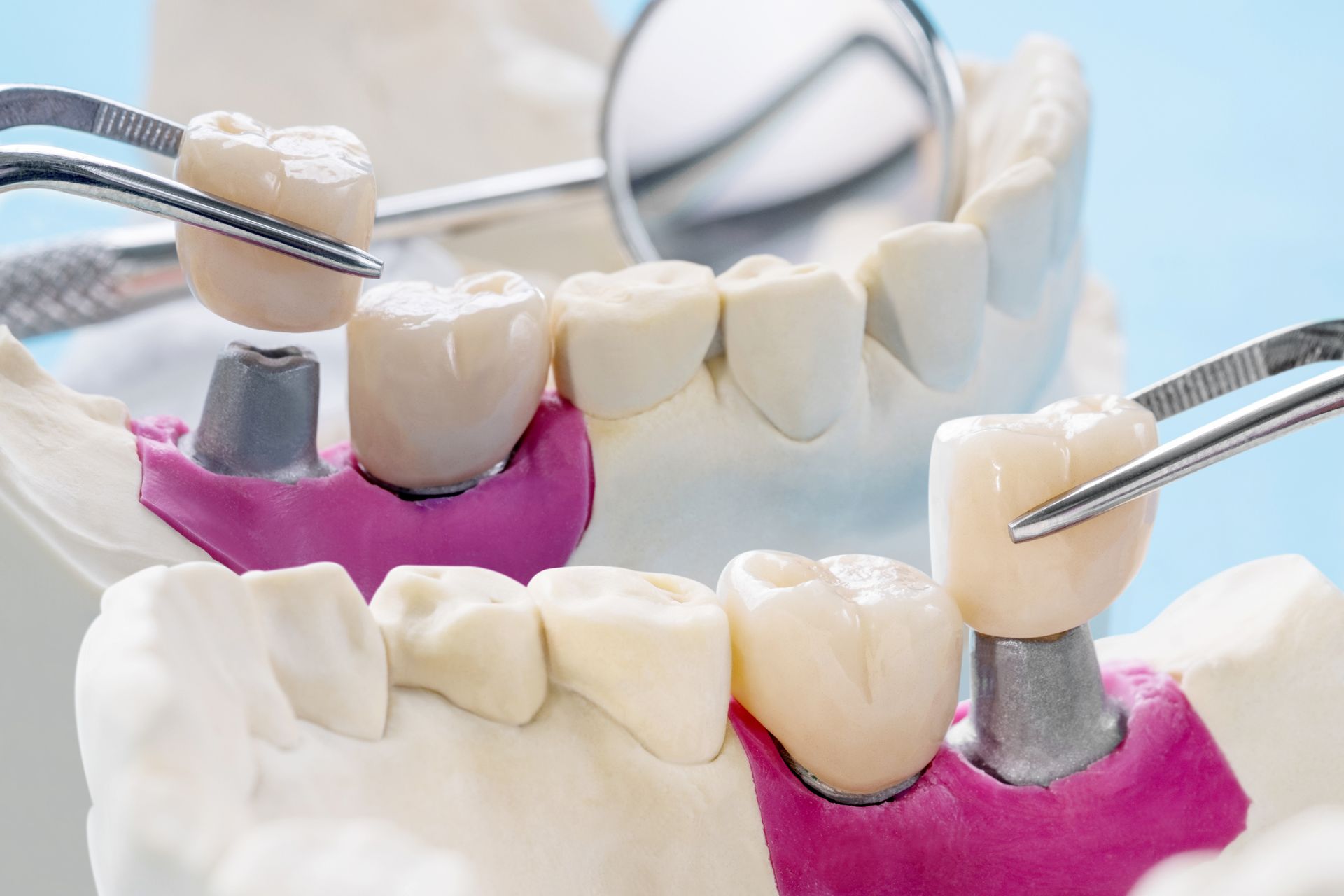 Close-up of two pliers holding dental crowns from a dental model with implants.