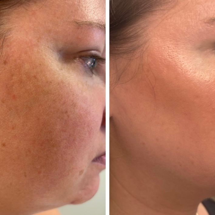 Side-by-side close-up profile of a cheek showing before-and-after skin texture and tone improvement