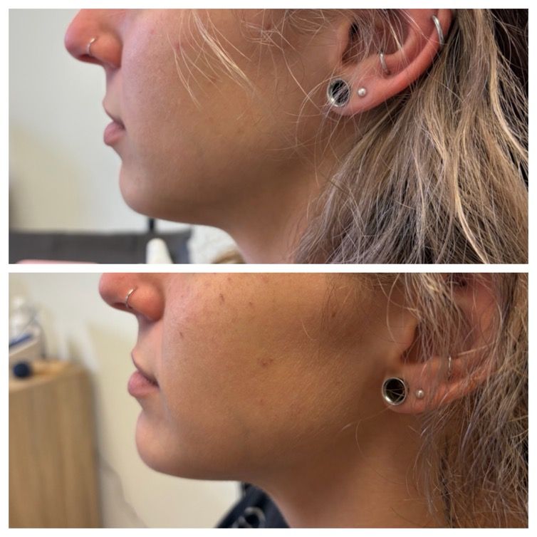 Side-profile before-and-after of a woman’s jaw and ear, showing a nose and ear piercing from two angles.