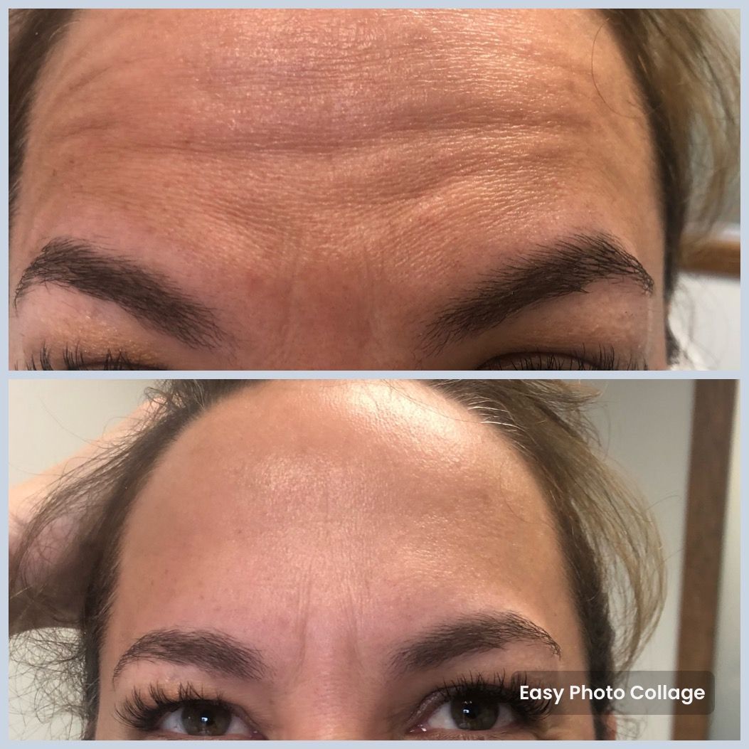 Close-up of a forehead before and after treatment, with reduced horizontal wrinkles in the lower image