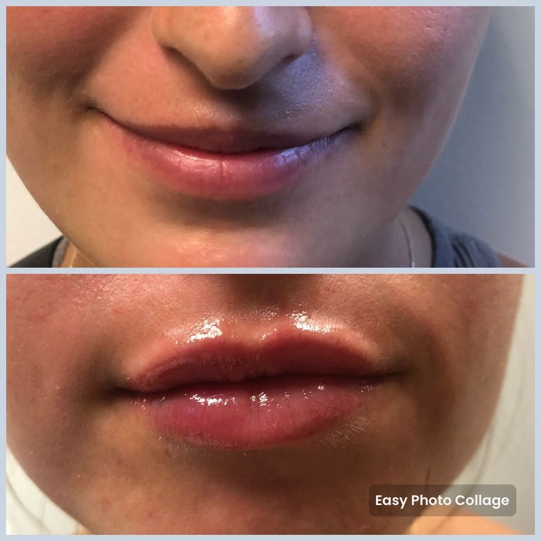 Close-up of lips, with a natural smile above and glossy swollen lips below.