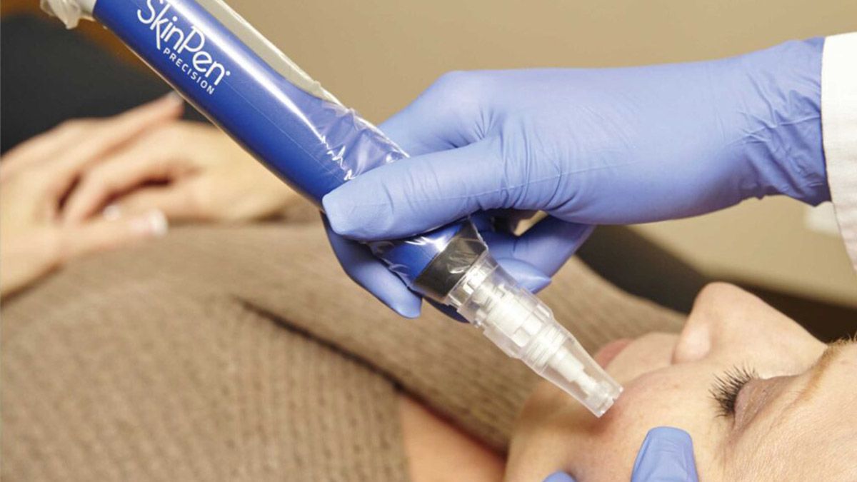 A person receiving a SkinPen microneedling treatment on their face; a gloved hand holds the device.