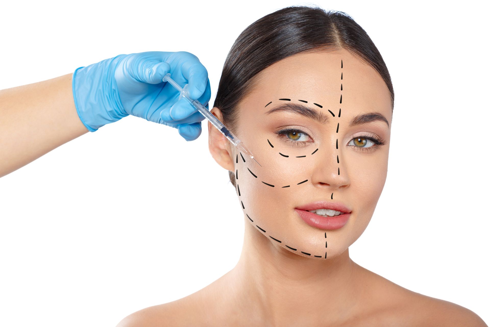 A person with surgical mapping lines on their face receives a facial injection from a gloved hand.