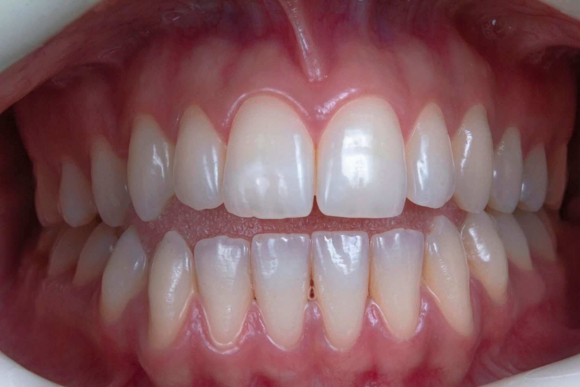 Close-up of a person’s open mouth showing aligned upper and lower teeth and pink gums