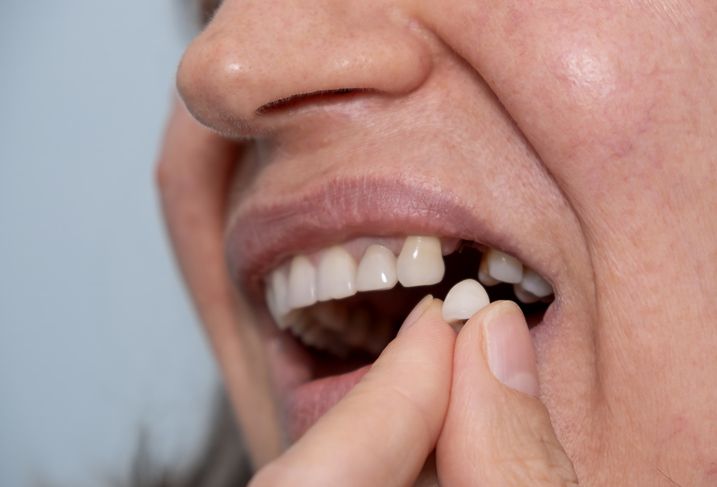 Person holding a dental crown next to a missing tooth in their mouth.