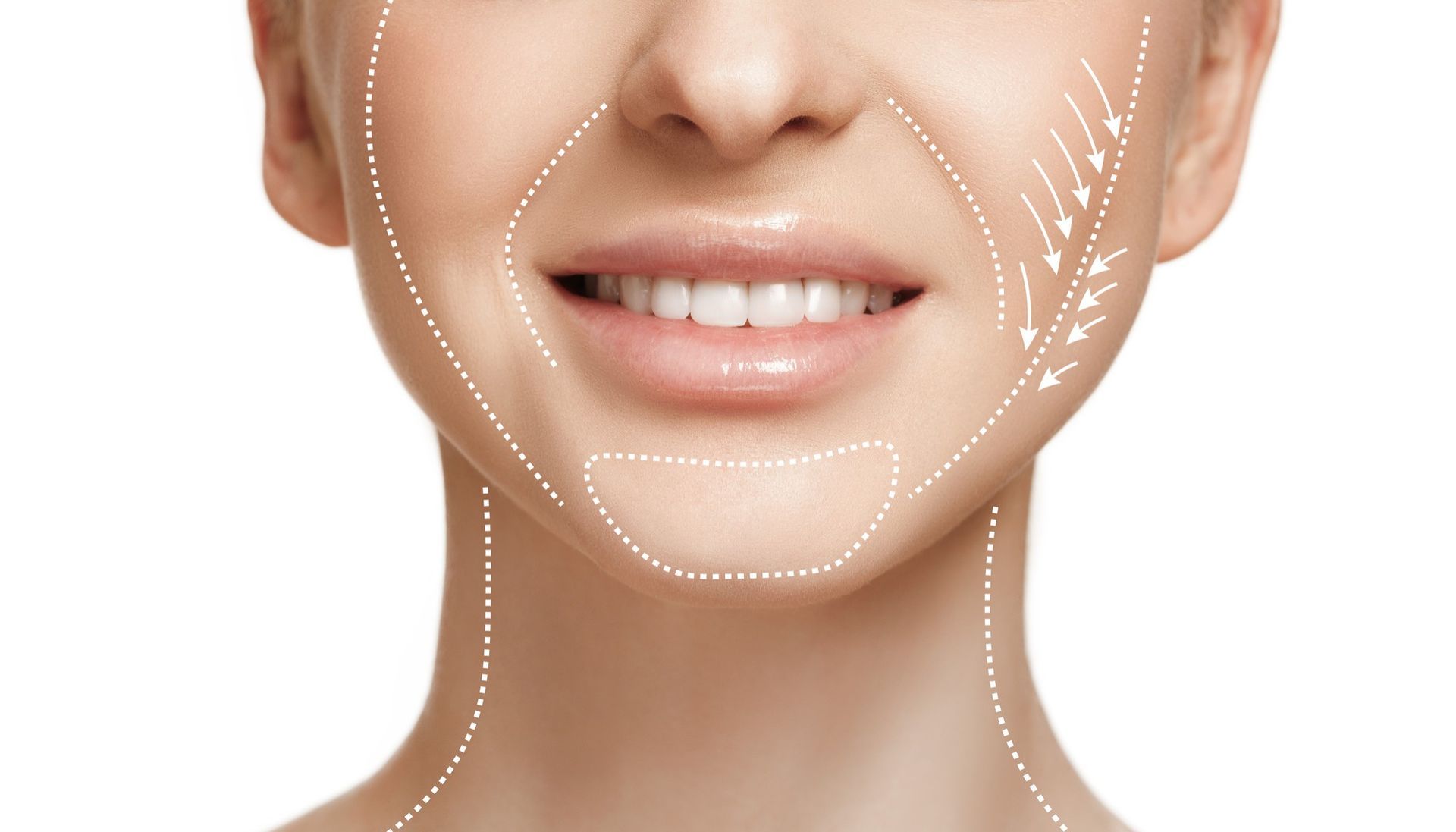 Close-up of a smiling mouth and jaw with dotted face contours highlighting facial treatment zones