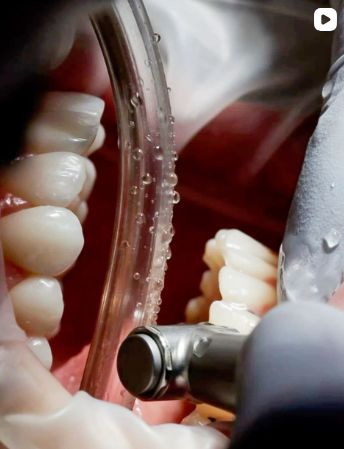 Dental drill working on a patient’s teeth with a cheek retractor in place