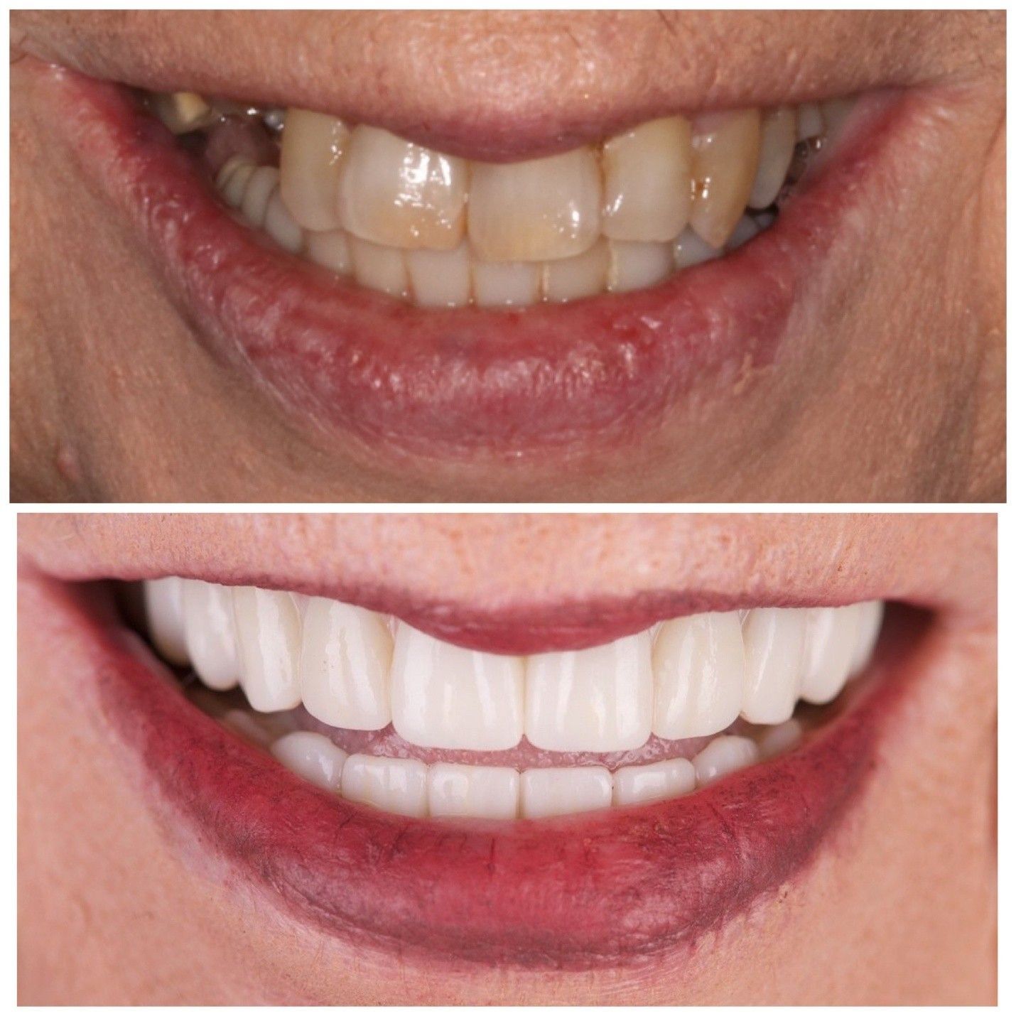 Before-and-after close-up of a smile with whiter teeth and red lips