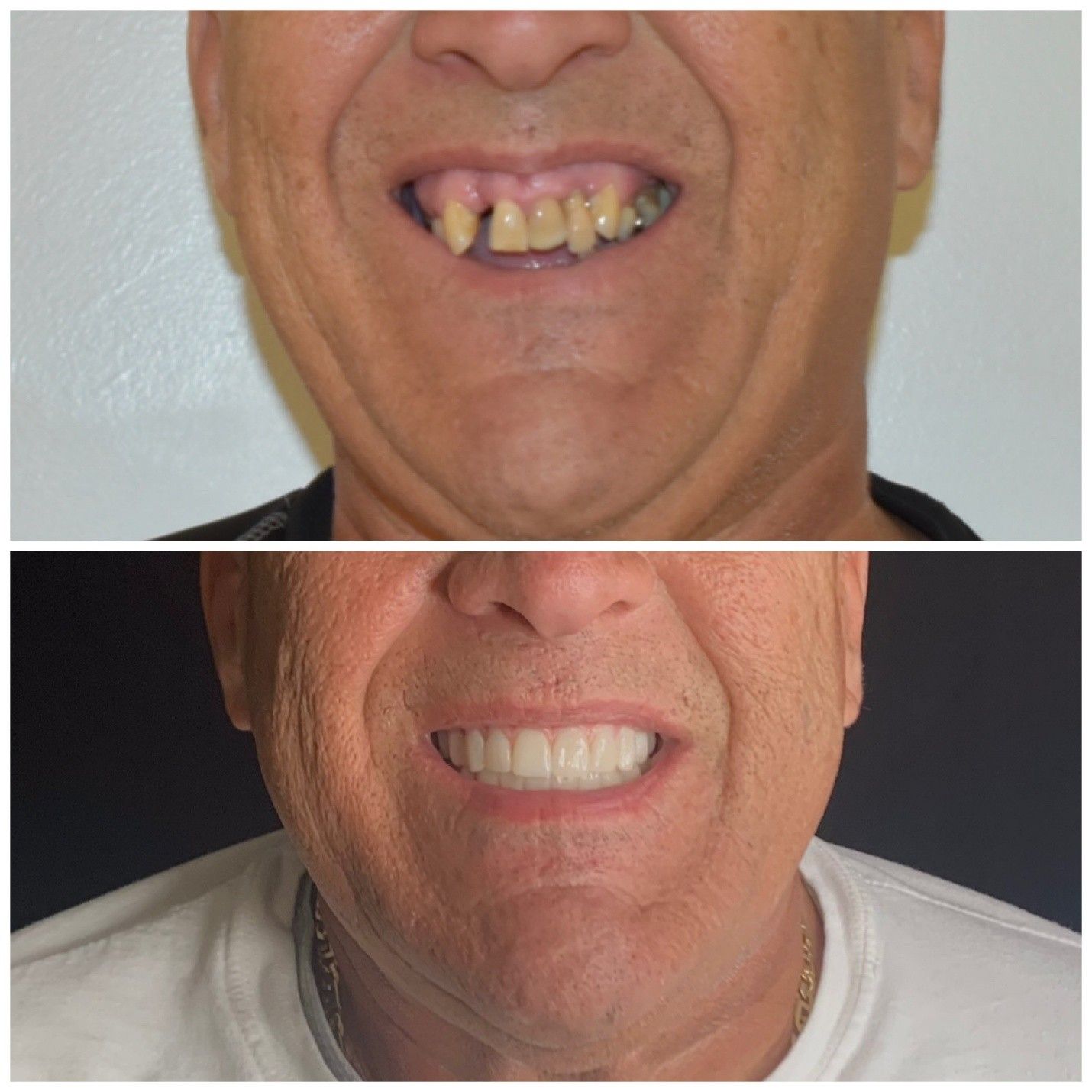 Before-and-after smile comparison showing discolored teeth above and white teeth below.