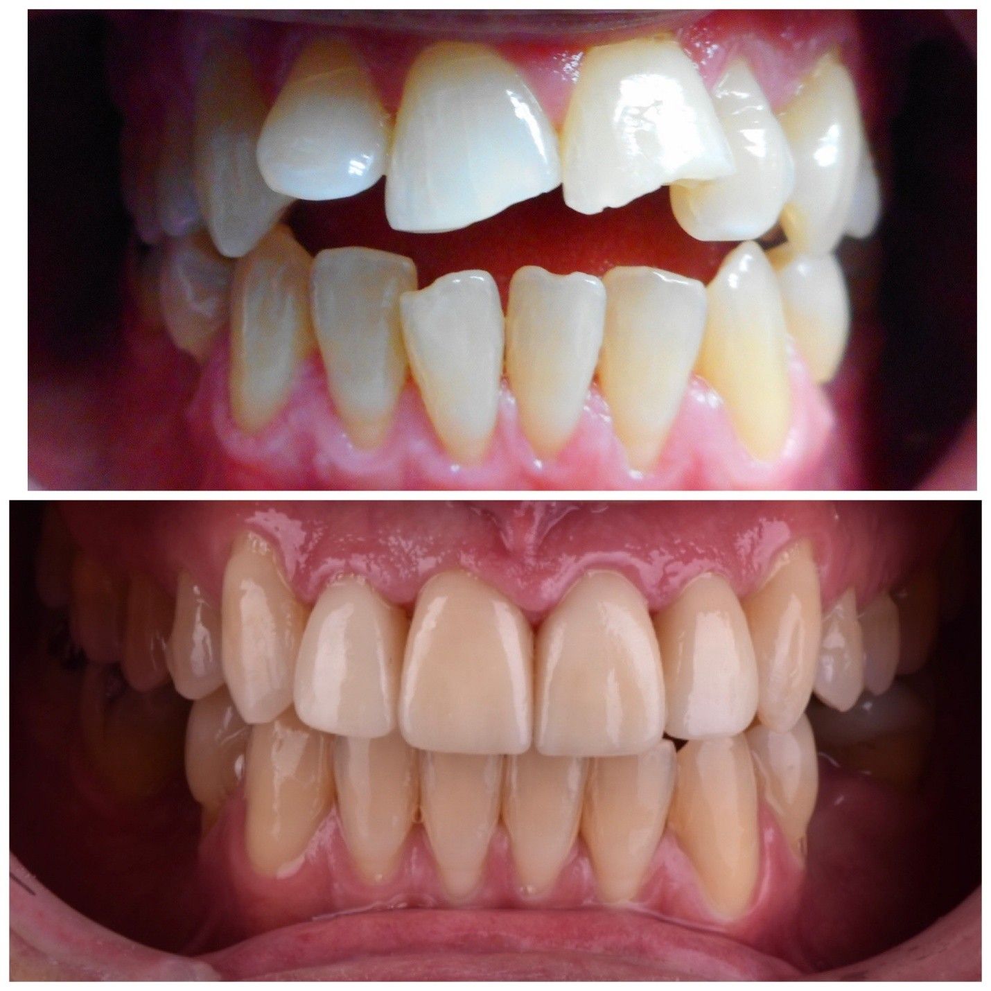 Before-and-after close-up of teeth: crooked, gapped teeth above, straighter aligned teeth below.