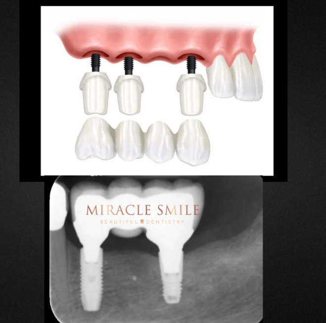 Dental implant and crown illustration with x-ray below showing two implants and a “MIRACLE SMILE” logo