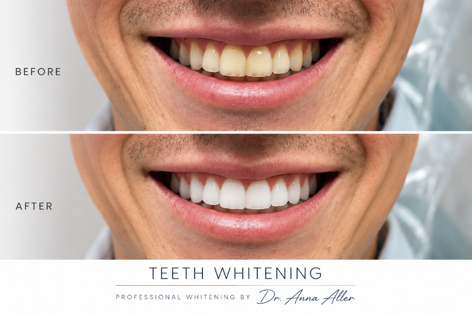 Before-and-after close-up of a smile showing teeth whitening results with brighter white teeth.