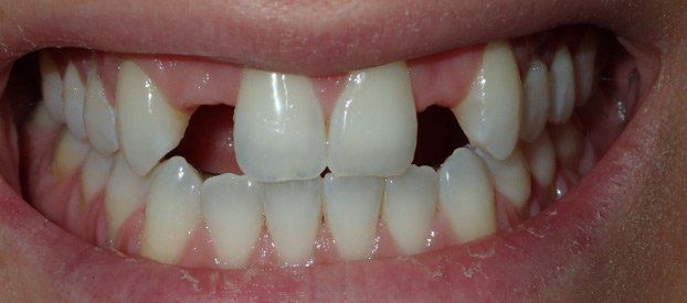 Dental Fillings Before