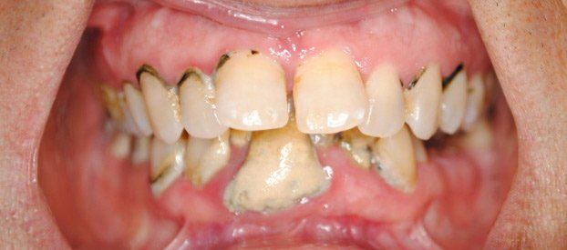 Dental Fillings Before