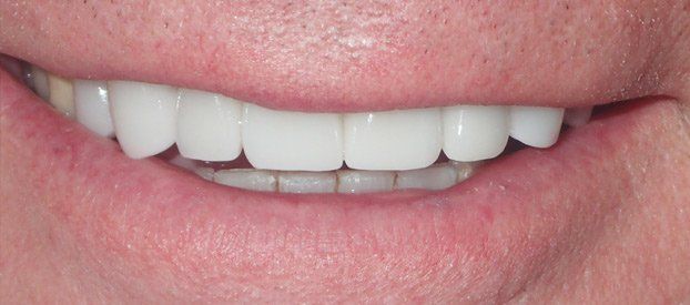 Dental Fillings Before
