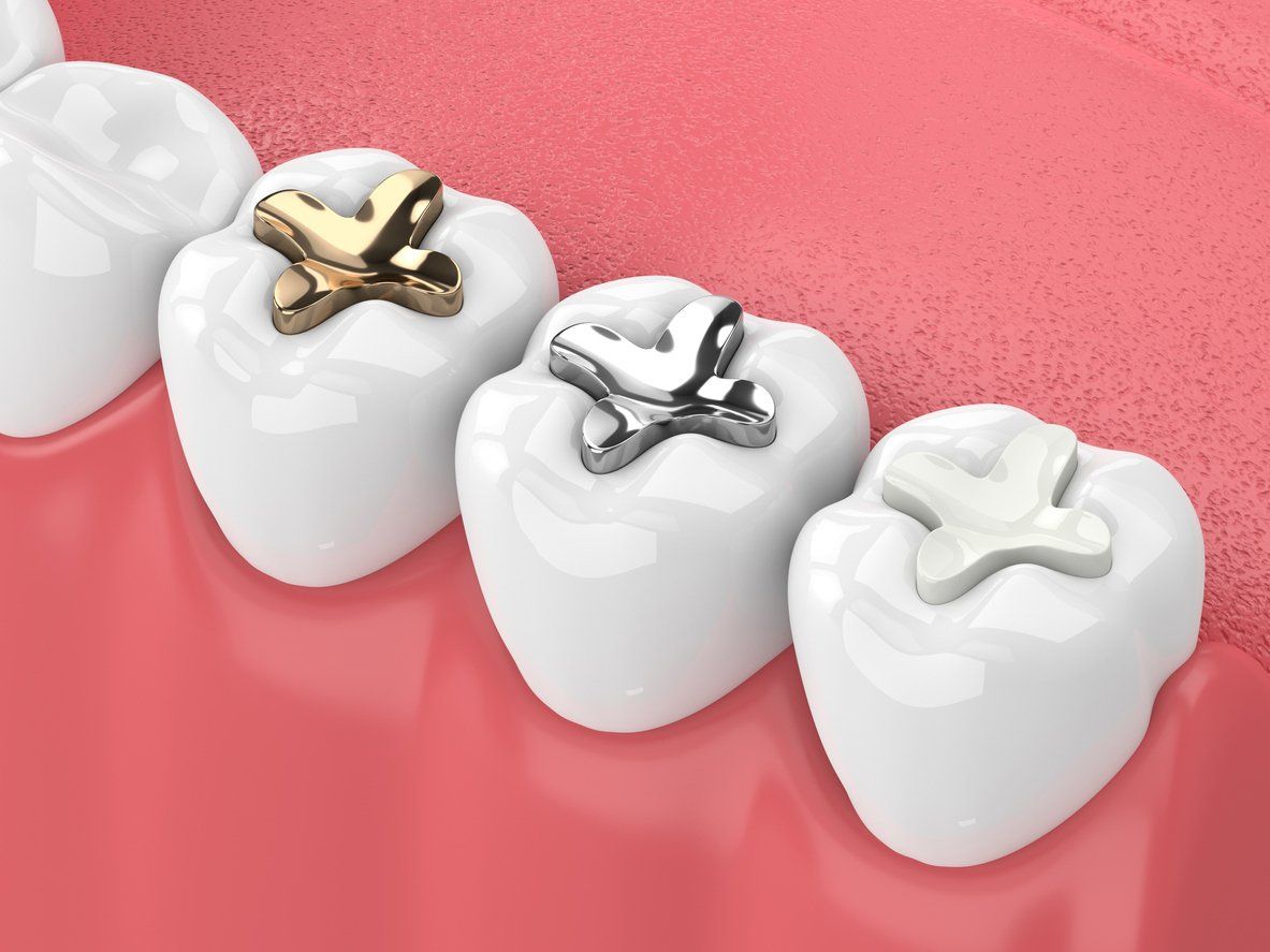 A close up of a row of teeth with fillings in them.