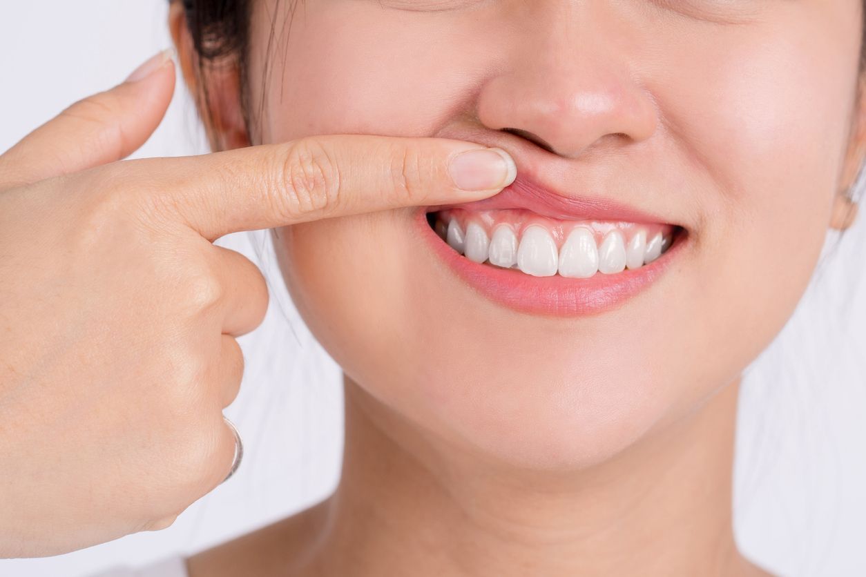 Woman pointing at her lip, showing white teeth, smiling.
