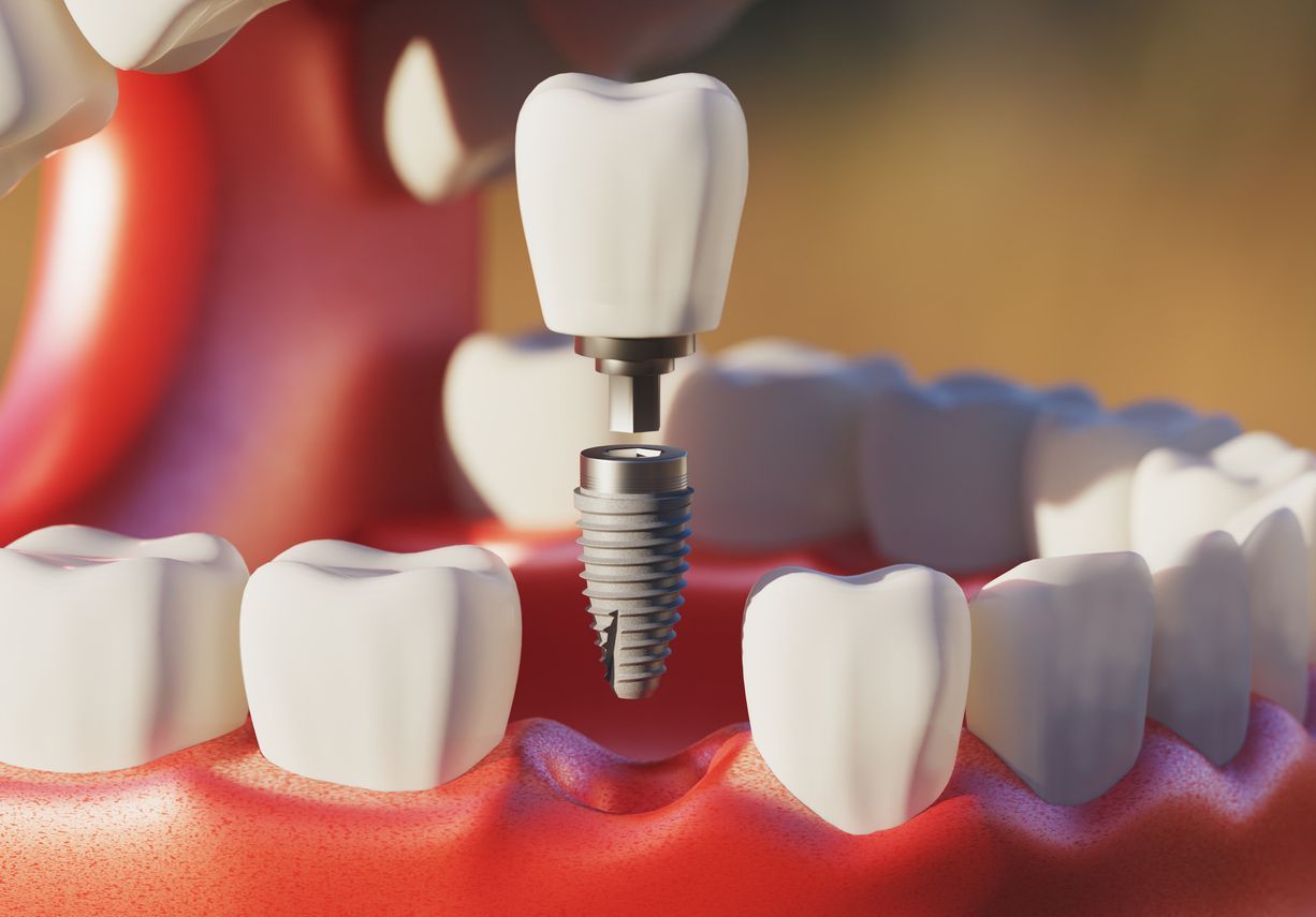 3D rendering of a dental implant screw placed in the gums with white teeth around it