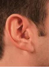 Custom In-the-Canal Hearing Aid