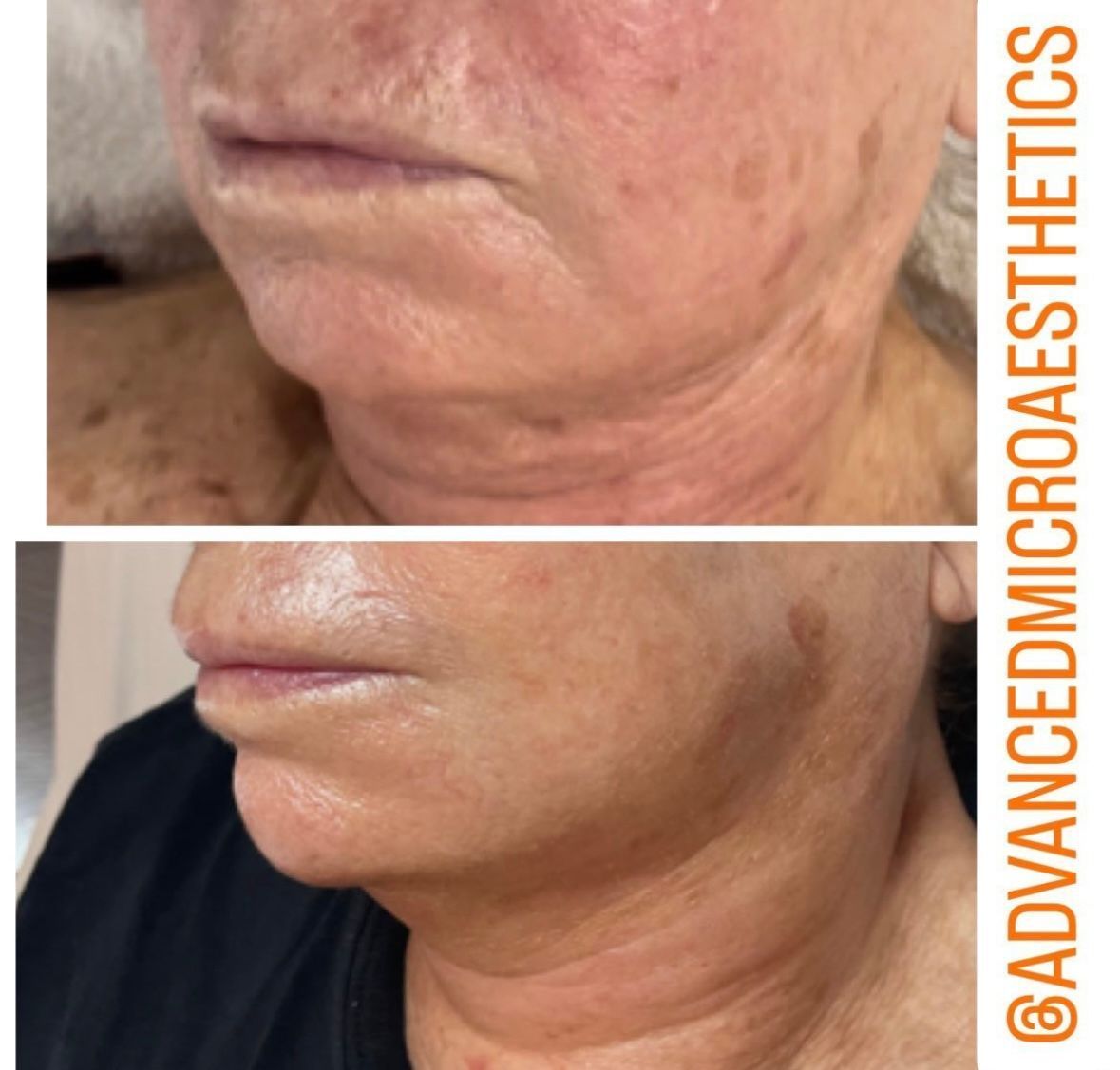 Before-and-after close-up of a lower face and neck showing reduced sagging and smoother skin.