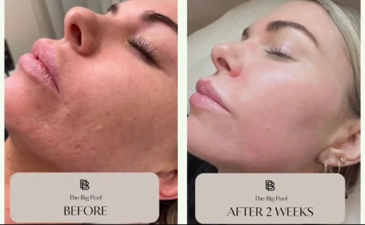 Before-and-after facial close-up: skin appears smoother after 2 weeks.