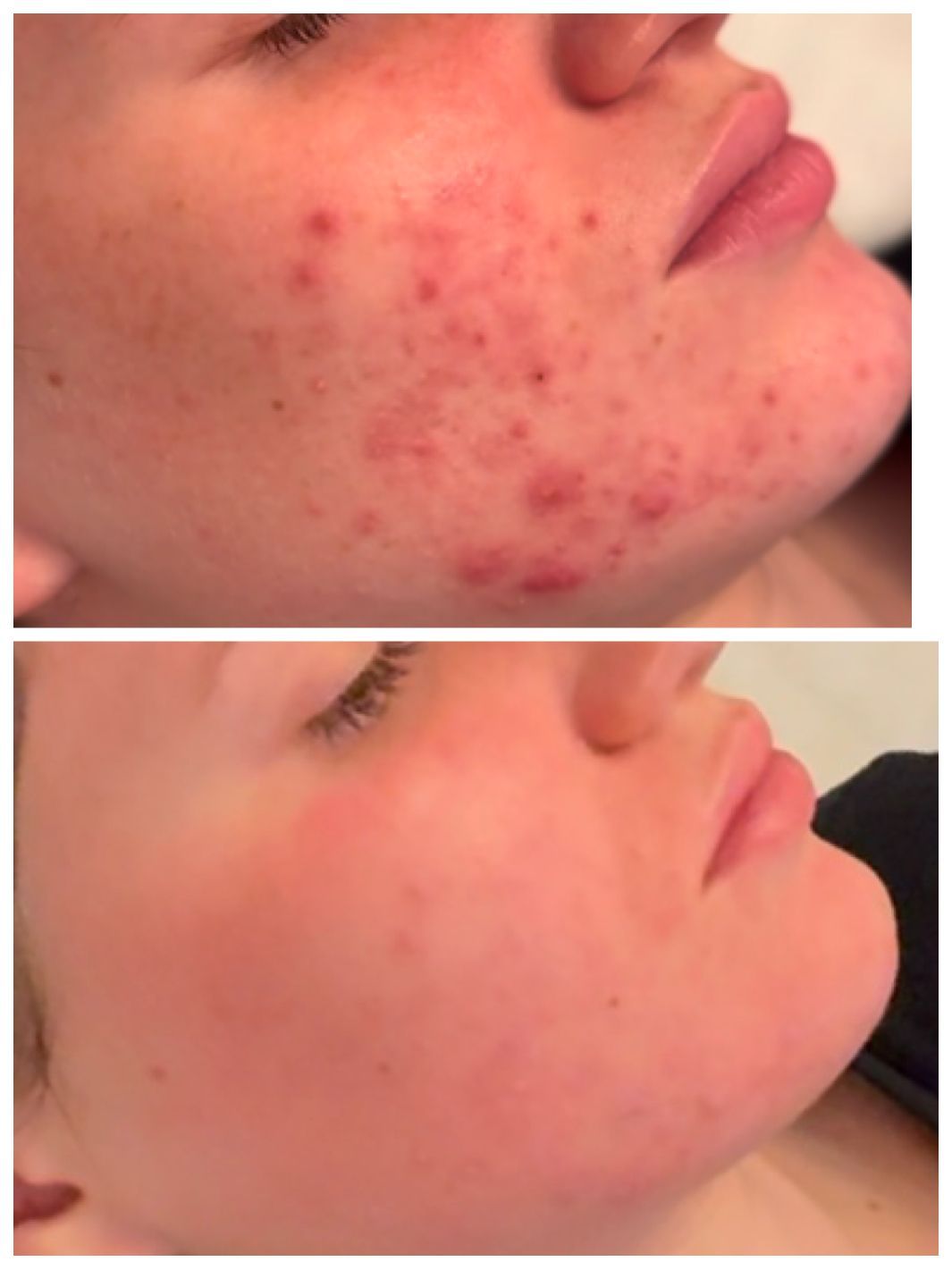 Close-up of a cheek with acne spots, shown before and after clearer skin treatment.