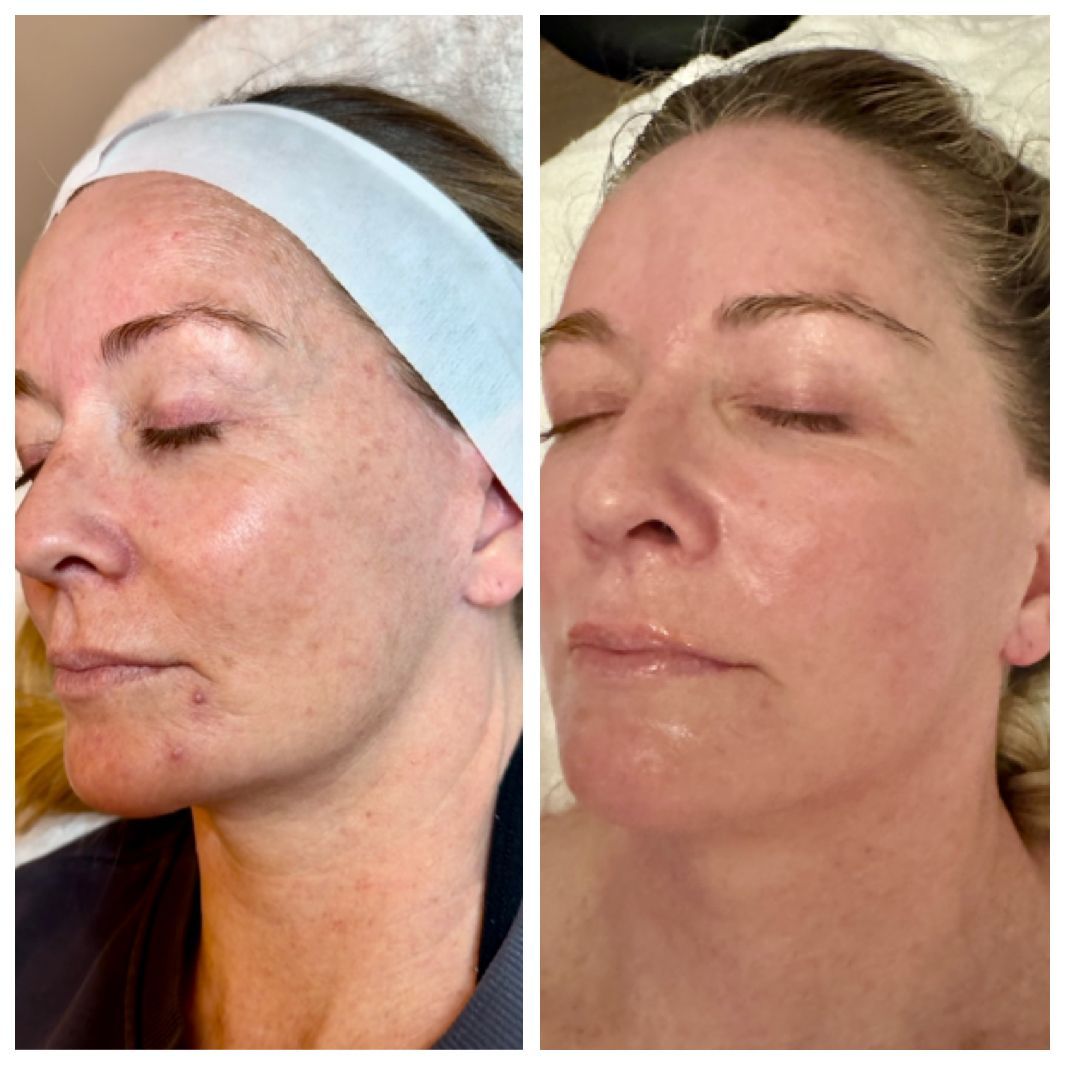 Side-by-side close-up face photos showing before and after skin treatment with reduced blemishes