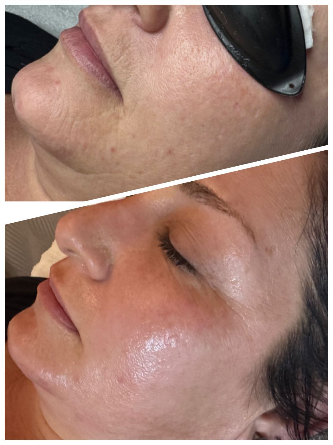Side-by-side close-up of a face before and after treatment, showing smoother skin and reduced cheek redness