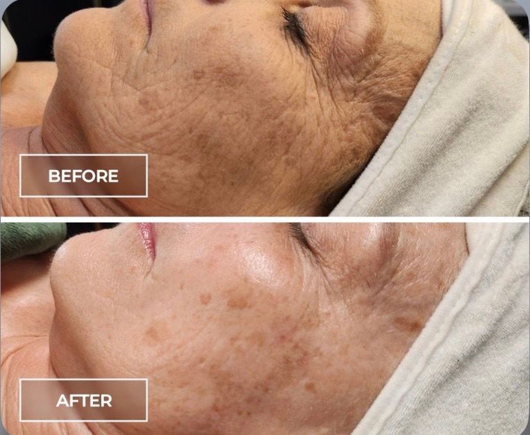 Side-by-side before and after close-up of facial skin showing reduced dark spots and smoother texture