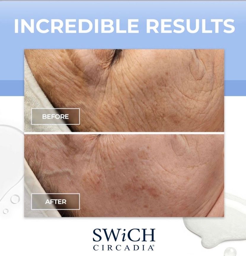 Before-and-after close-up of skin under “Incredible Results” with SwiCH Circa branding, showing reduced wrinkles.
