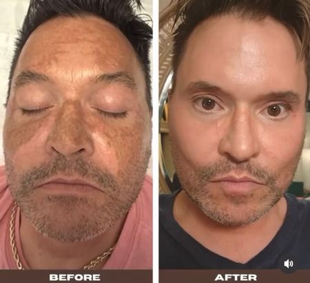 Before and after skin treatment result