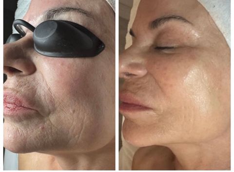 Before and after facial treatment result
