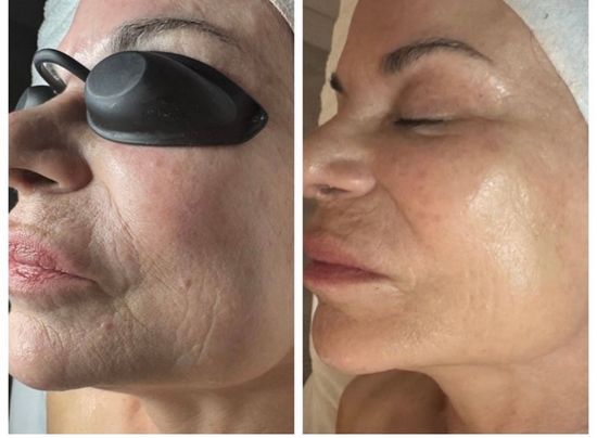 Renew and lift skincare treatment