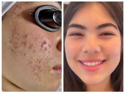 Before and after skin renewal result
