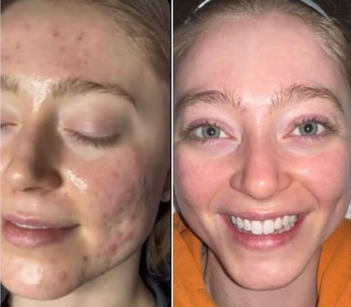 Clear skin acne treatment