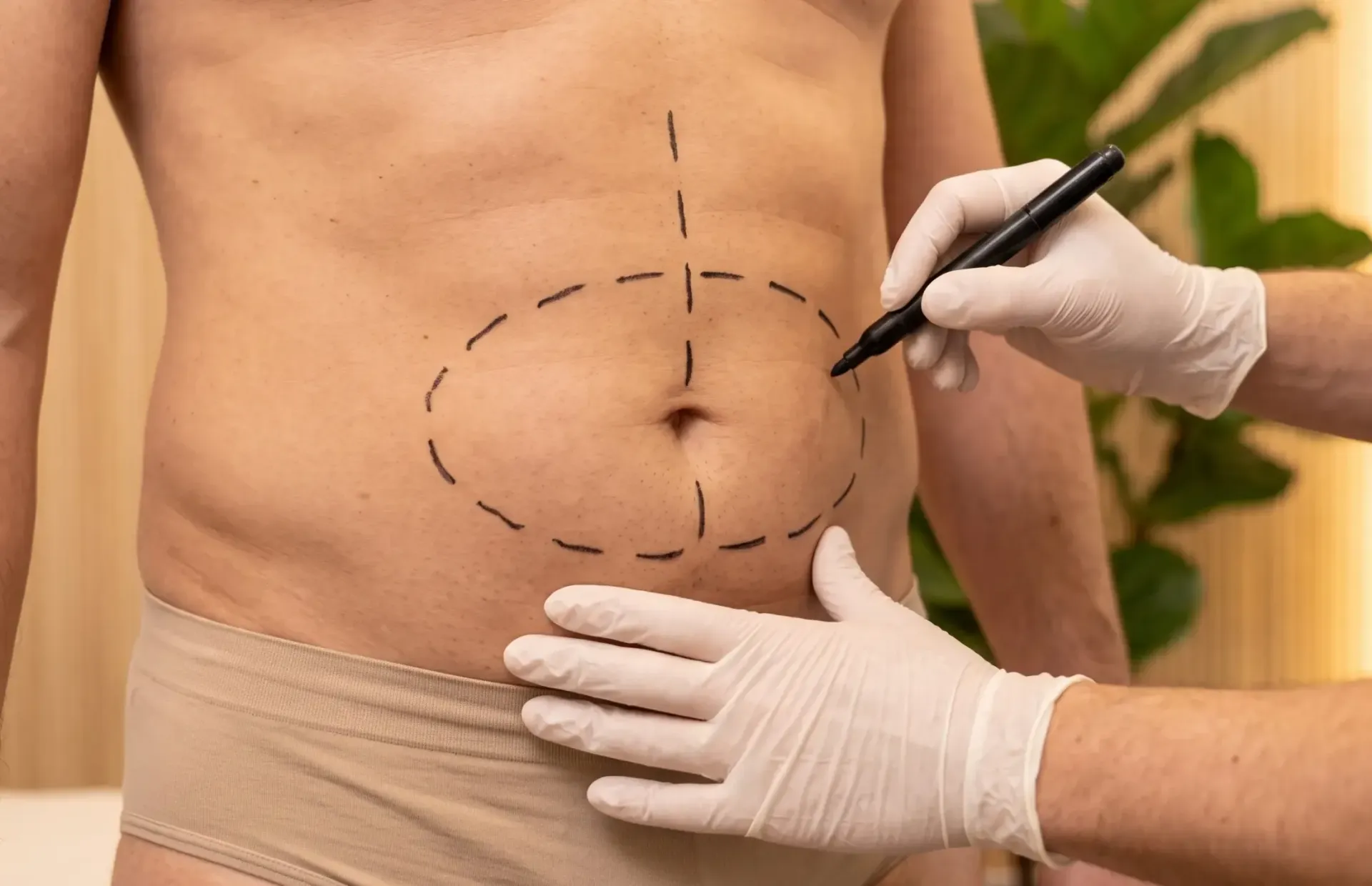 Procedimento de cirurgia plástica para o abdome