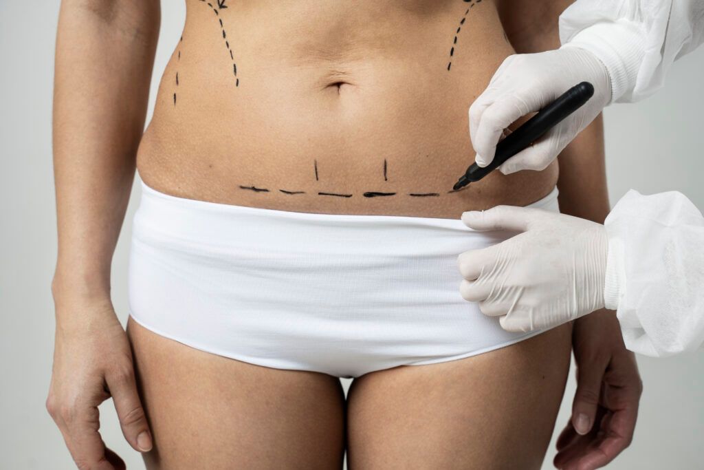 Hands marking a torso for cosmetic surgery near the waist and abdomen
