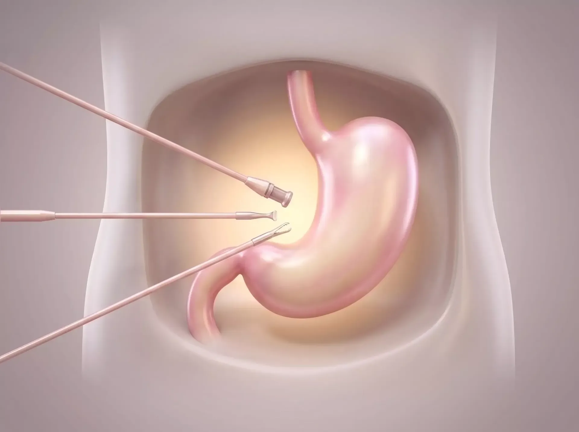 Ilustração médica de instrumentos laparoscópicos operando um estômago em uma cavidade abdominal.