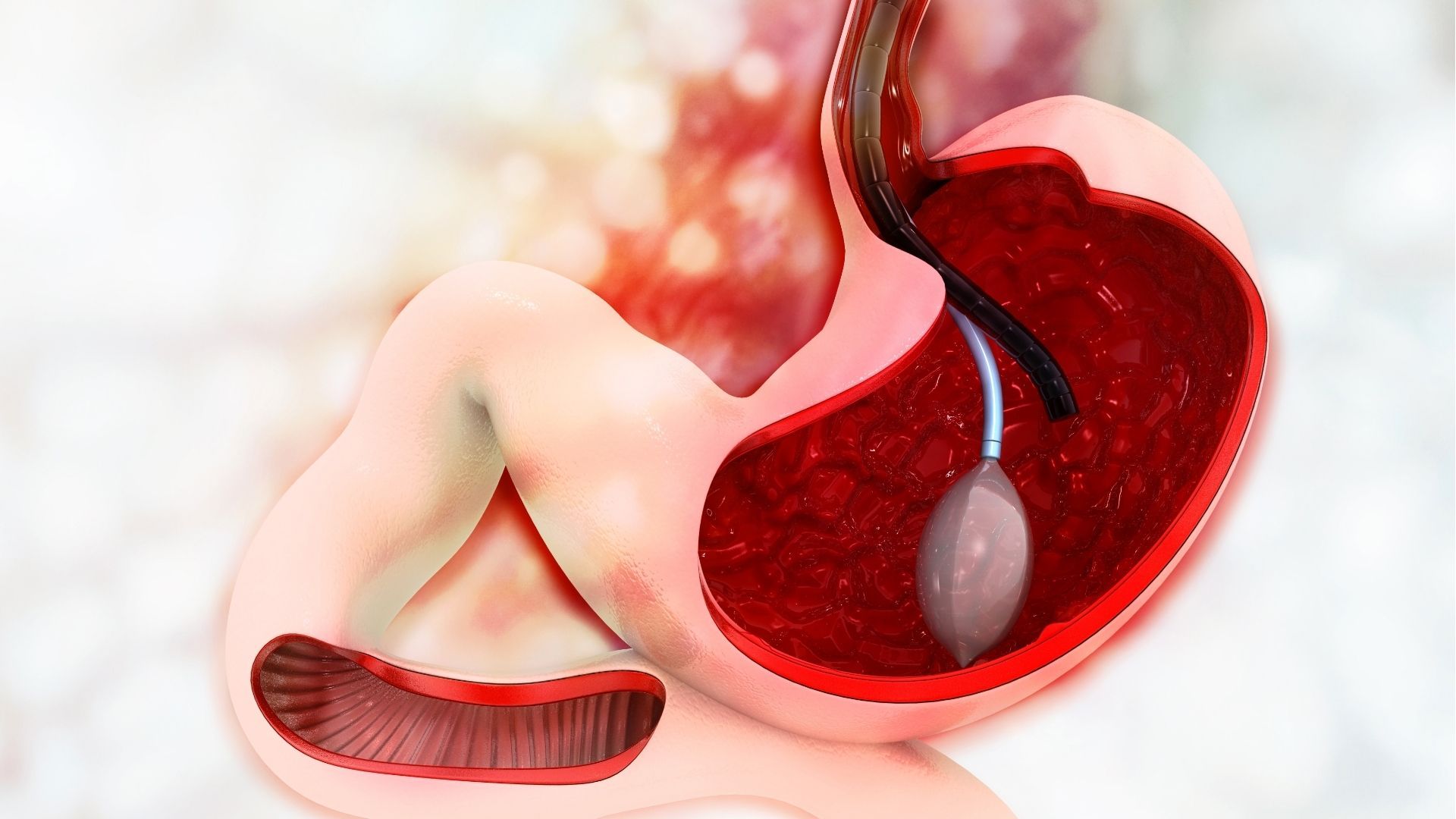 Ilustração do balão gástrico posicionado dentro do estômago por endoscopia.