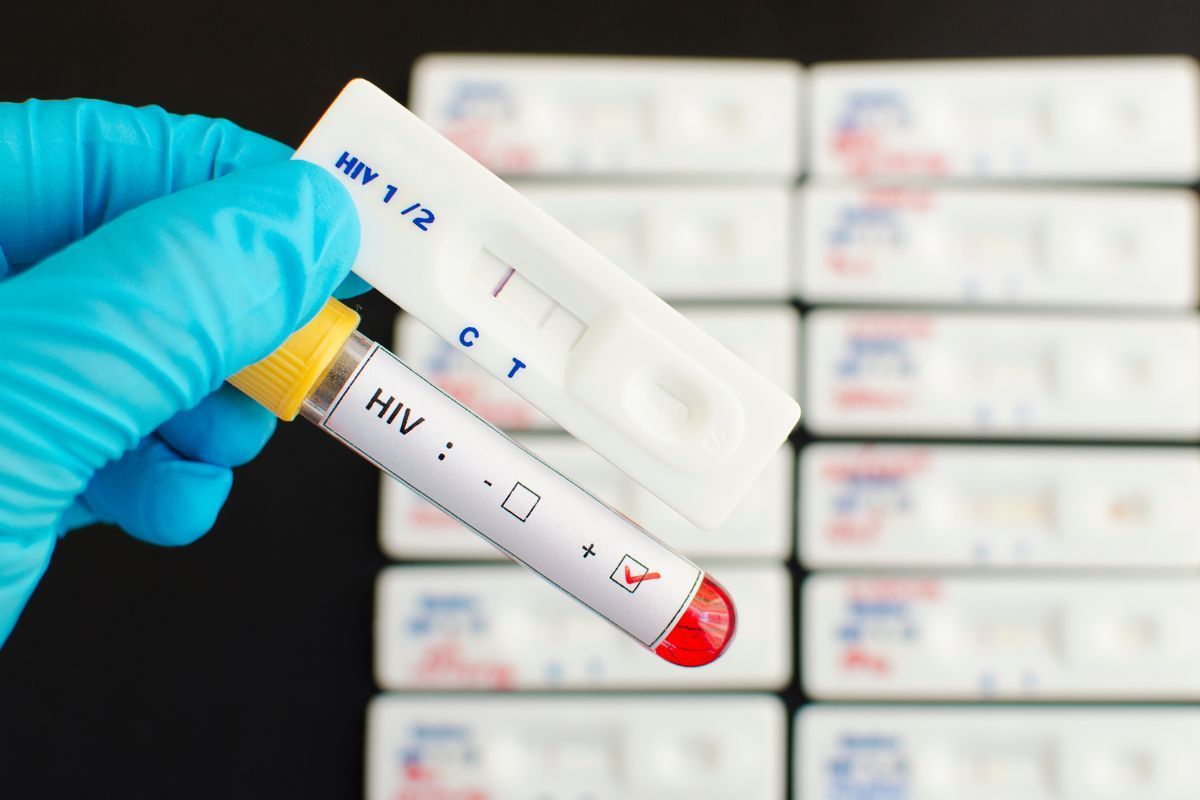AIDS-e-HIV-teste-dr-eder-rocha-urologista-picos-piaui