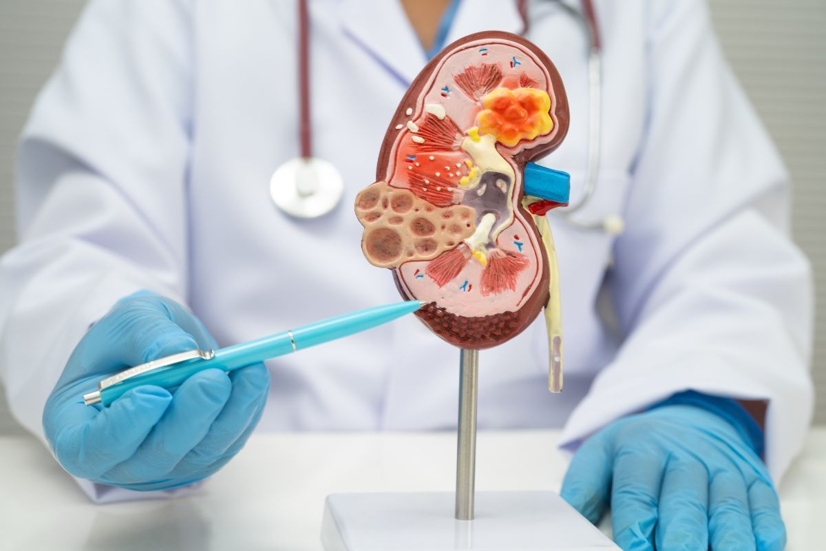 Câncer de rim: conheça os fatores e como prevenir